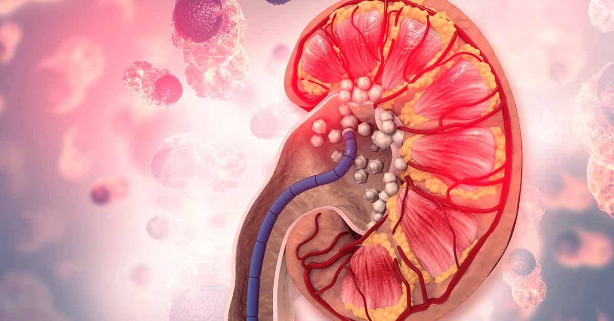 Fique por dentro das novas tendências no tratamento da litíase Fique por dentro das novas tendências no tratamento da litíase